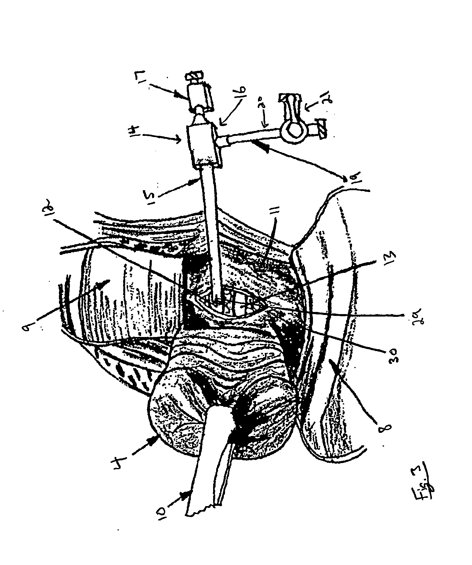Method and device for canulation and occlusion of uterine arteries