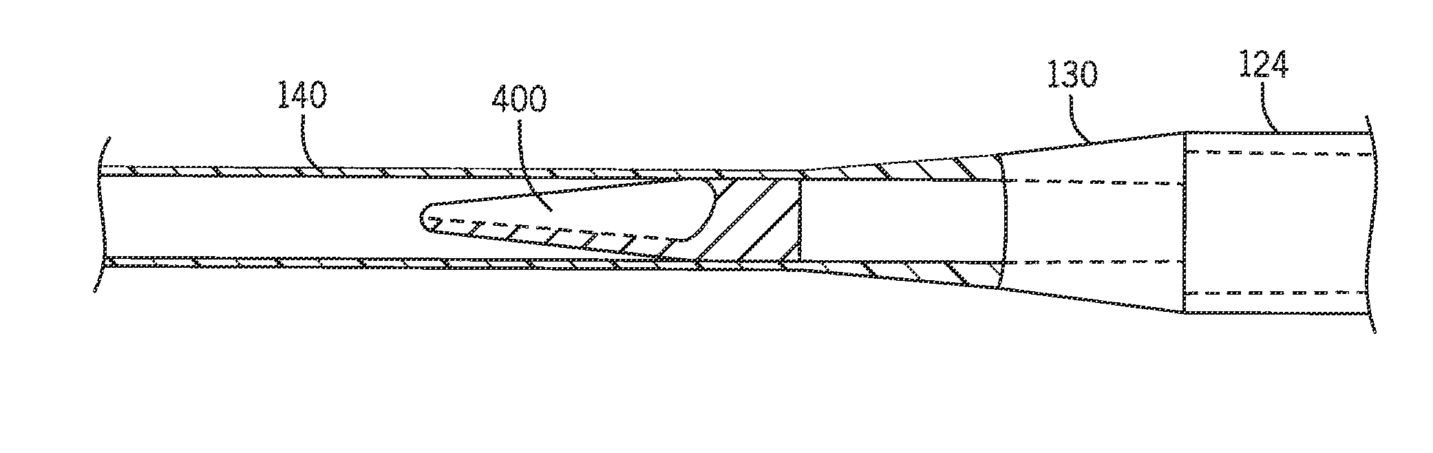 System and method for use of flexible Anti-reflux ureteral stent