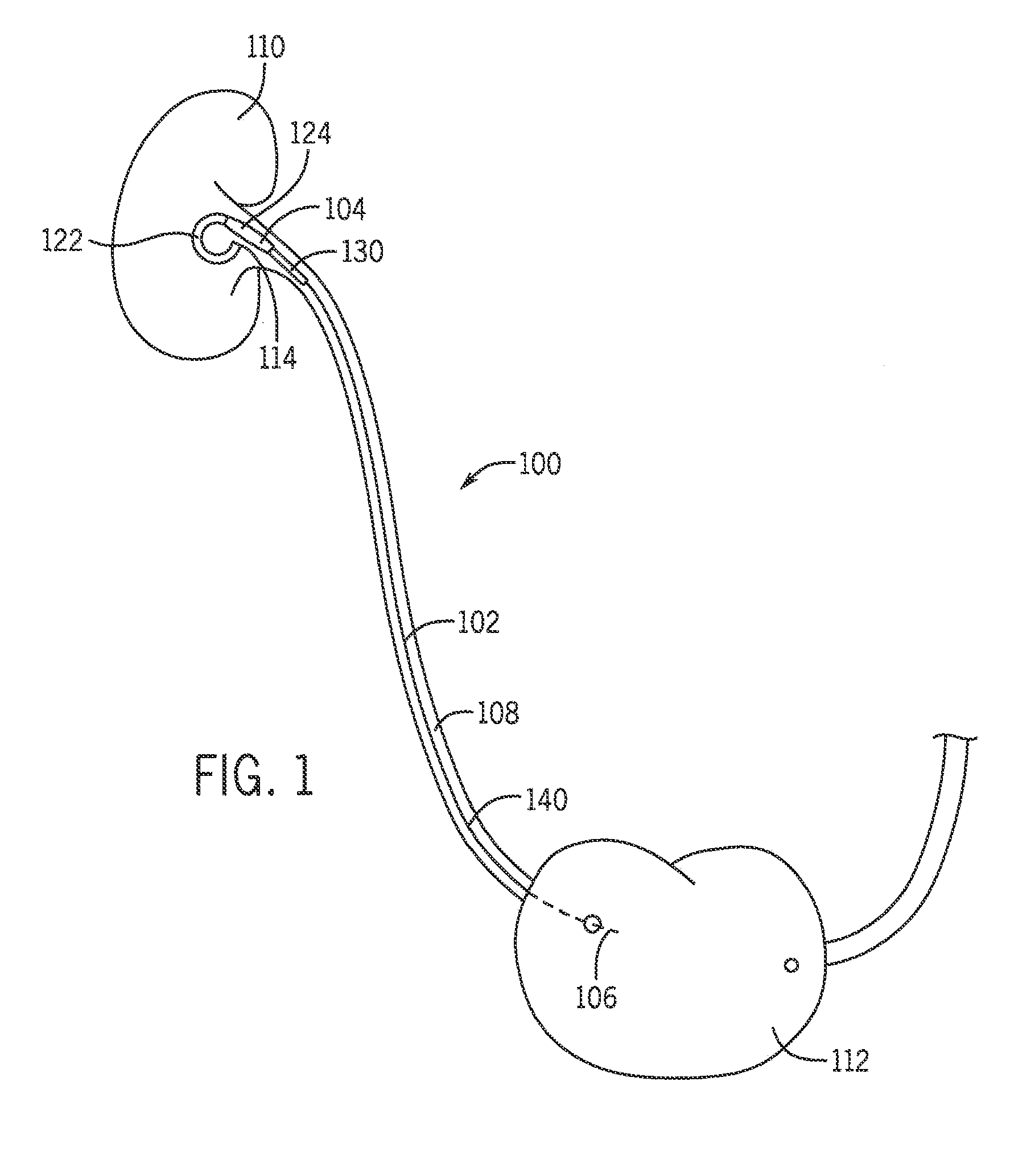 System and method for use of flexible Anti-reflux ureteral stent