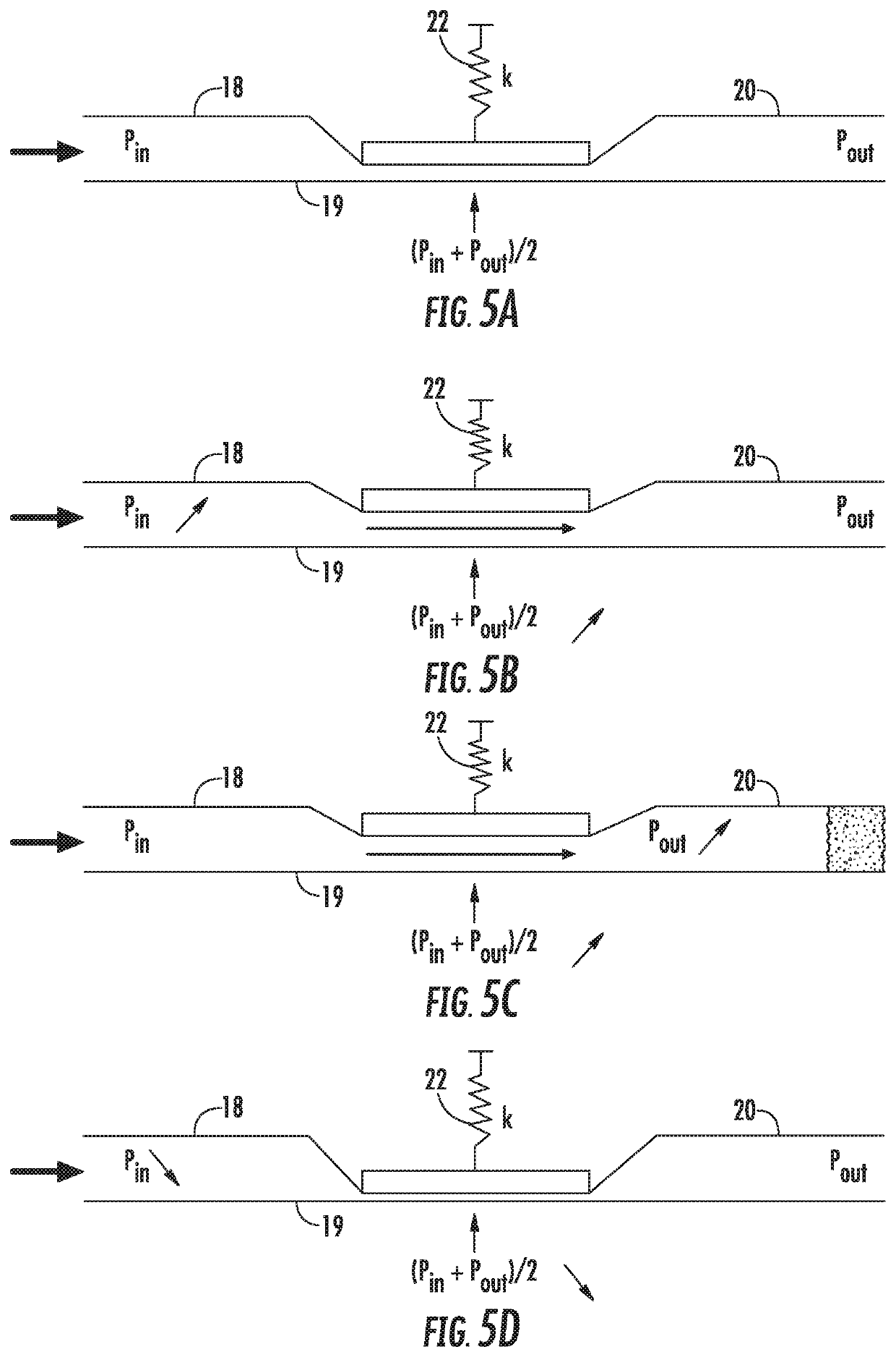 Apparatus for treating excess intraocular fluid