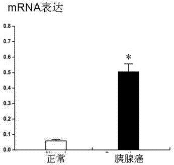 Tumor markers associated with pancreatic cancer and application thereof