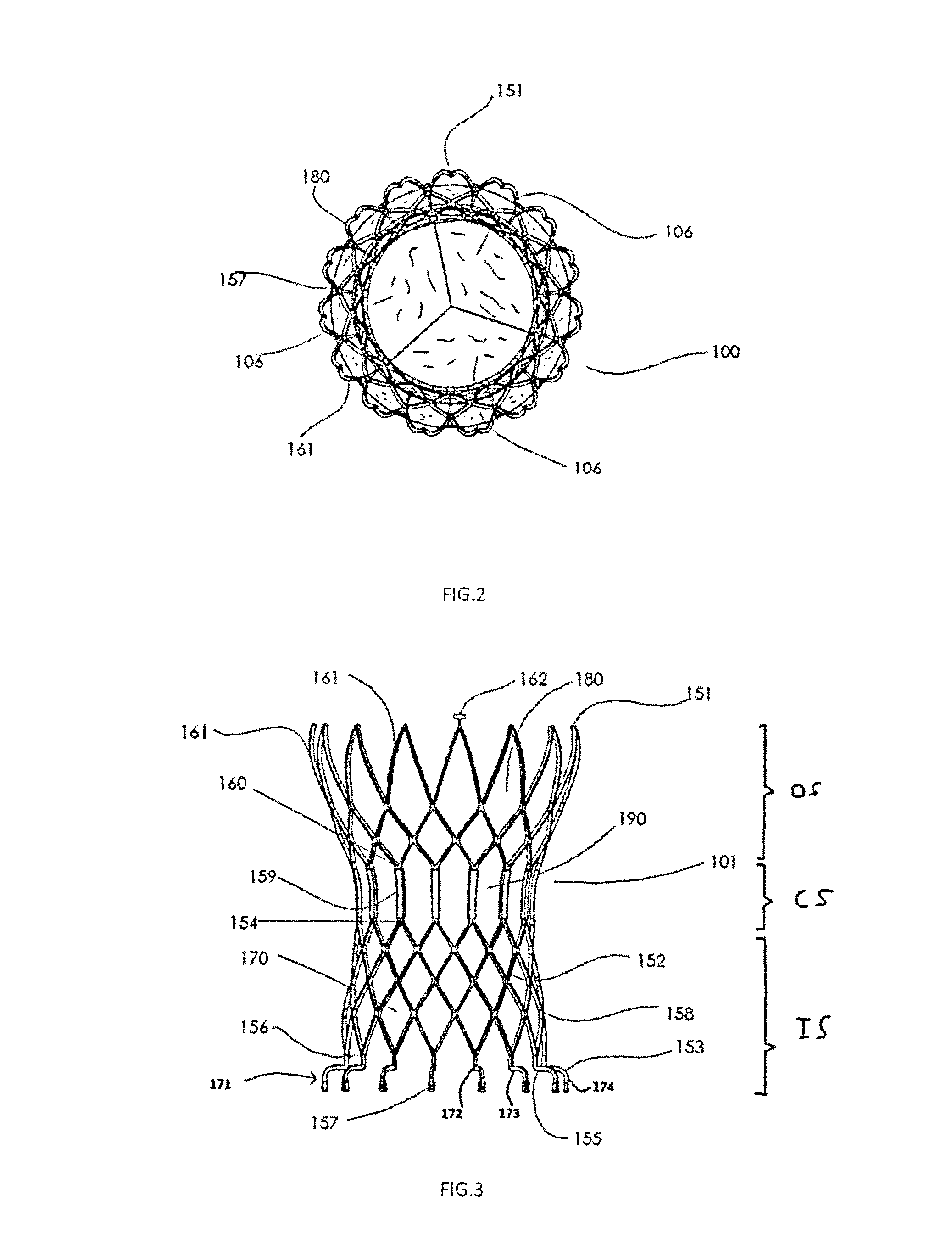 Aortic Replacement Valve