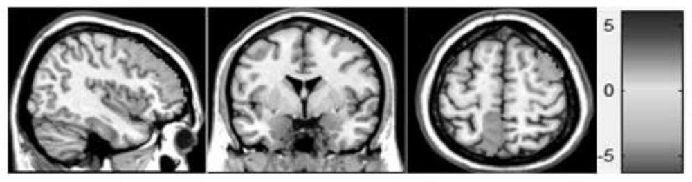 Effective connection method for coupling relationship of different brain regions of teenager patient with myoclonus epilepsy