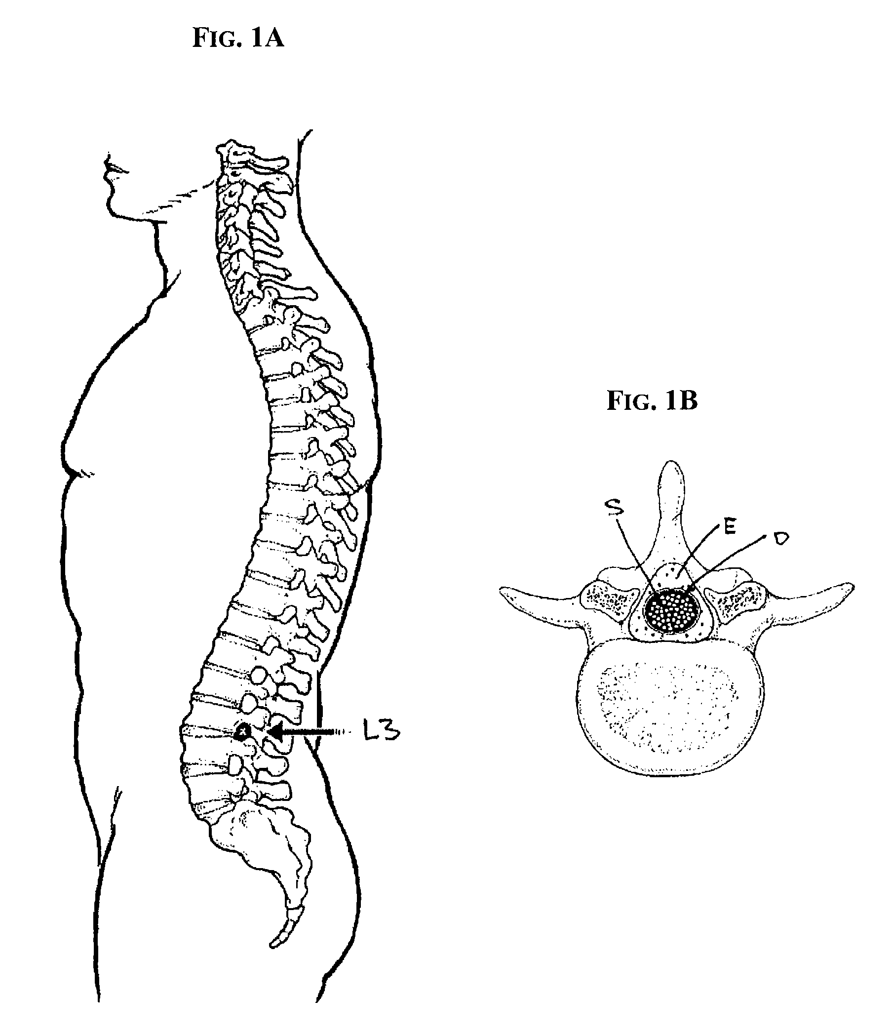 Subarachnoid epidural shunt