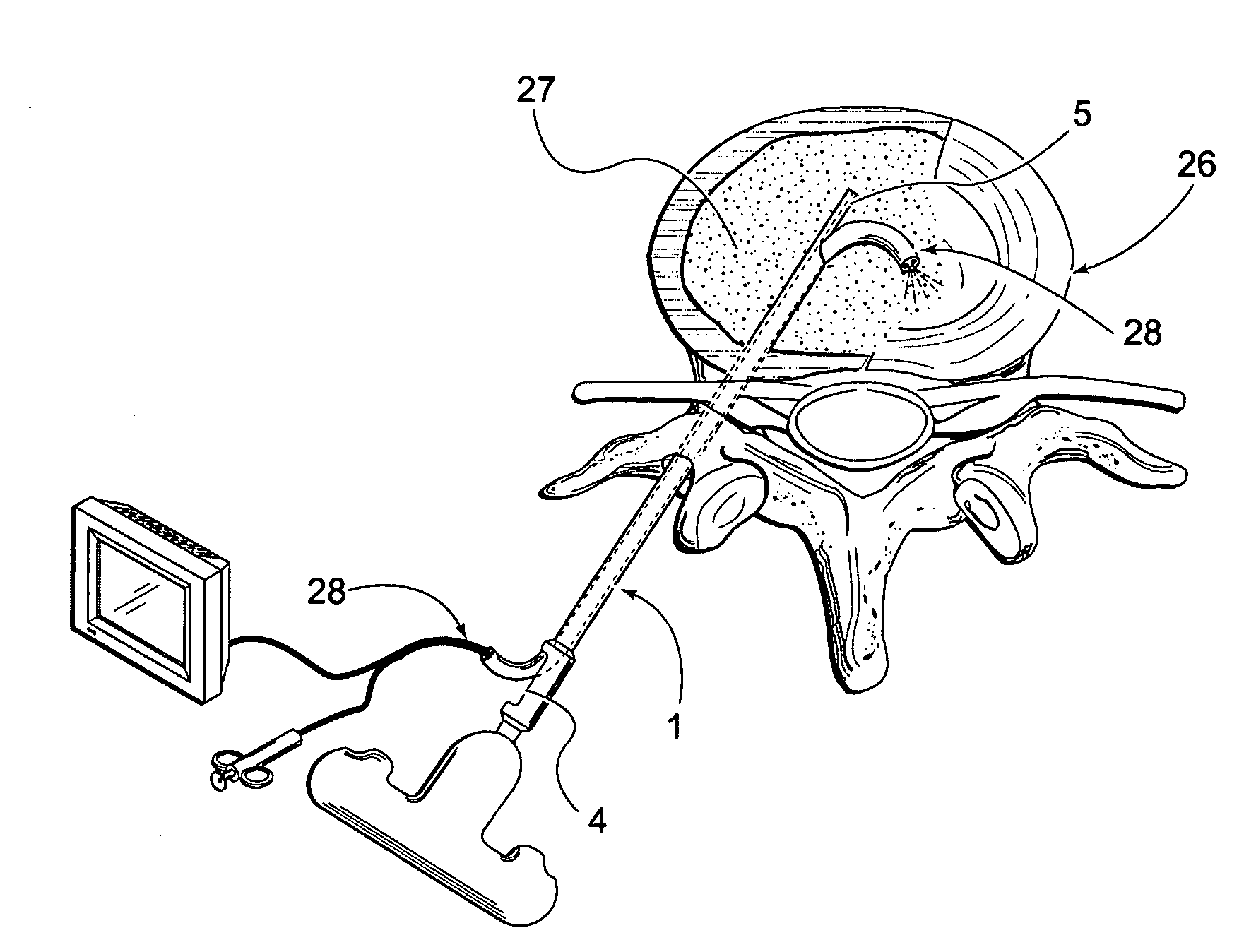 Device and method for introducing flowable material into a body cavity