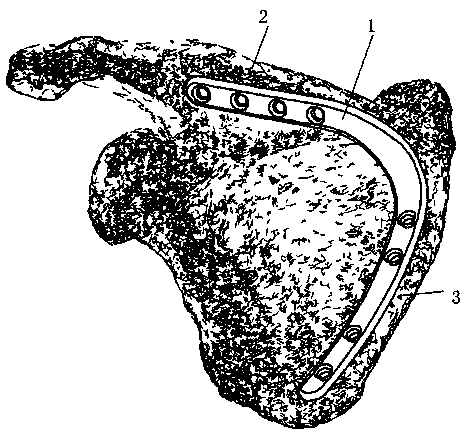 Scapula bone fracture plate