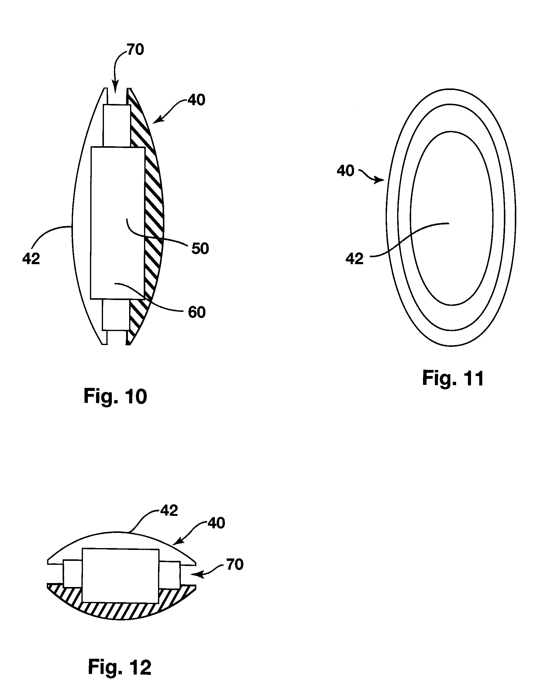 Dynamic arch stabilization and rehabilitative shoe insole device