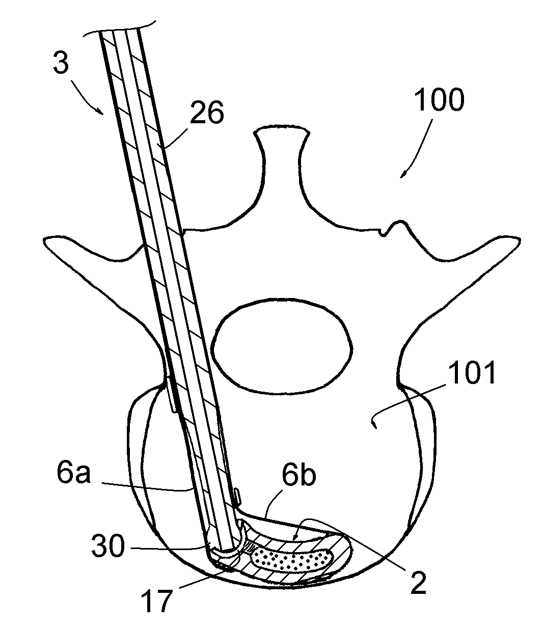 Set comprising an intervertebral implant for immobilising a vertebra with respect to another and an instrument for installing this implant
