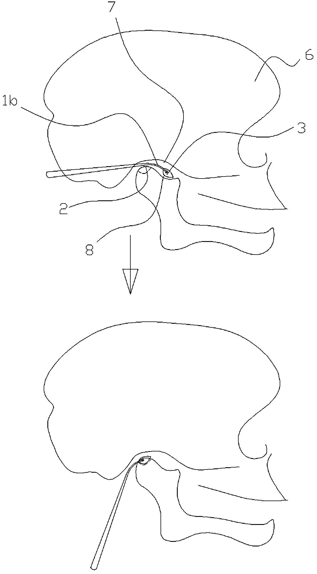 Mandibular condyle sagittal fracture reduction forceps