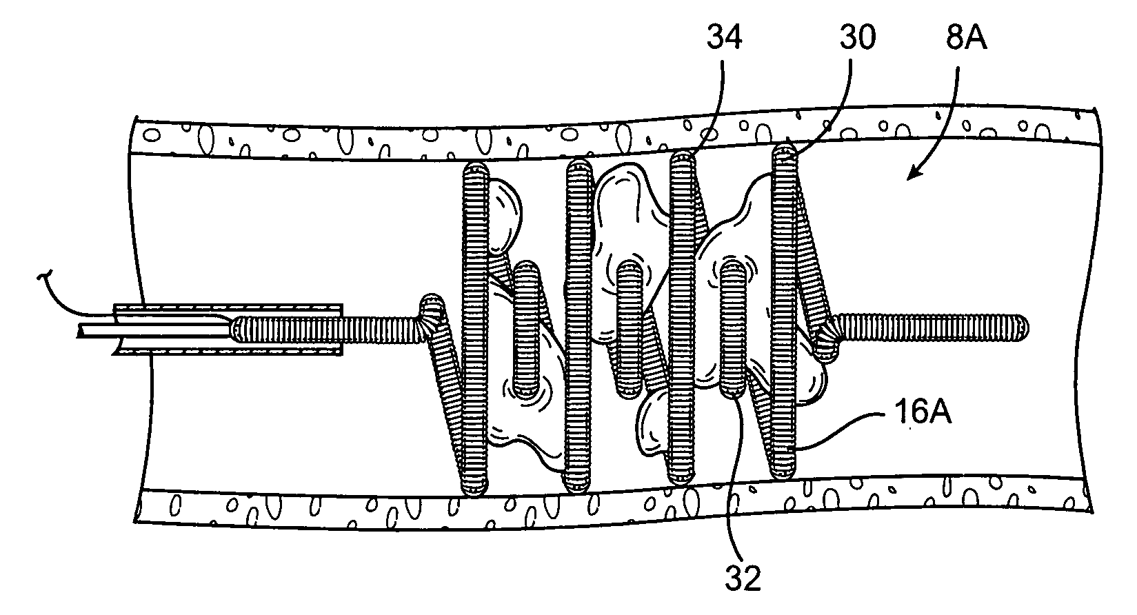 Systems, methods and devices for removing obstructions from a blood vessel