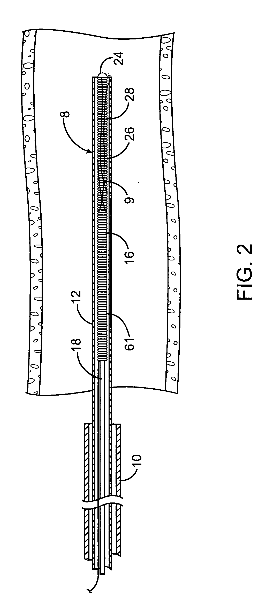 Systems, methods and devices for removing obstructions from a blood vessel