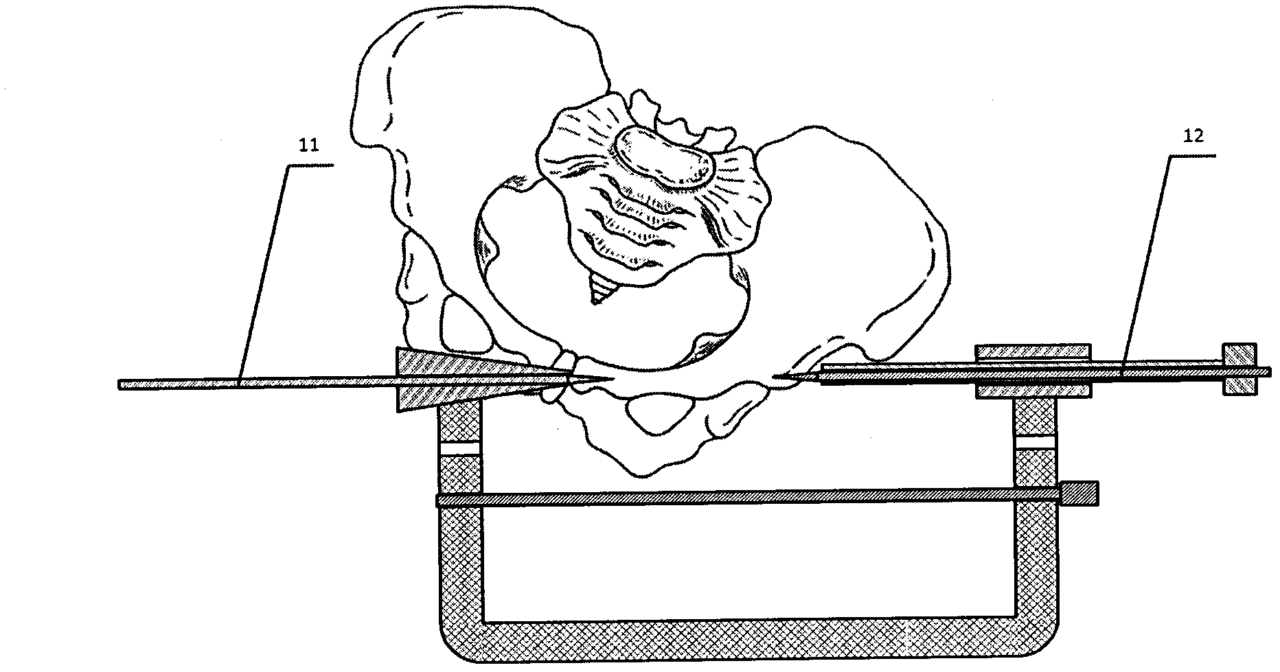 Transdermal screw fixation in vitro sighting device for treating pelvic fracture