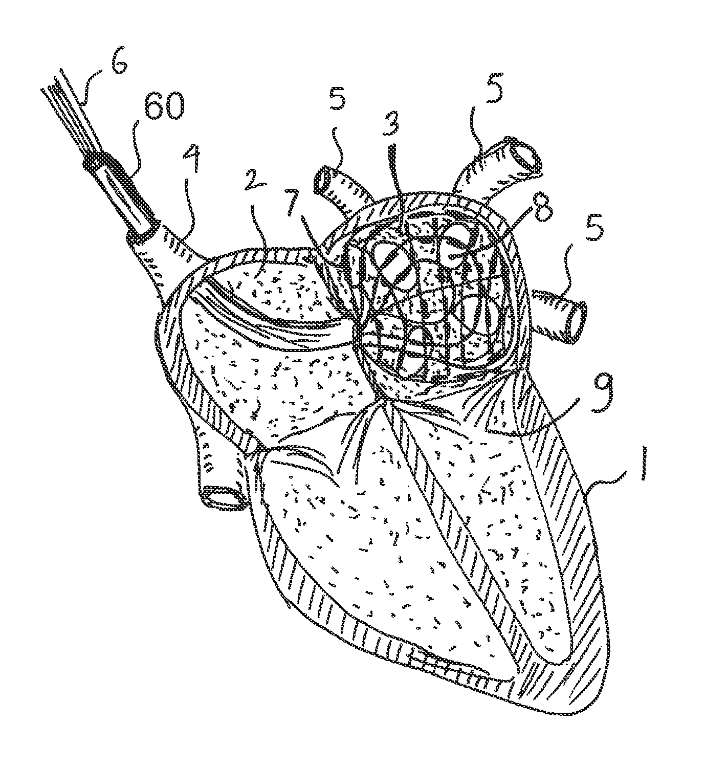 Apparatus and method for intra-cardiac mapping and ablation