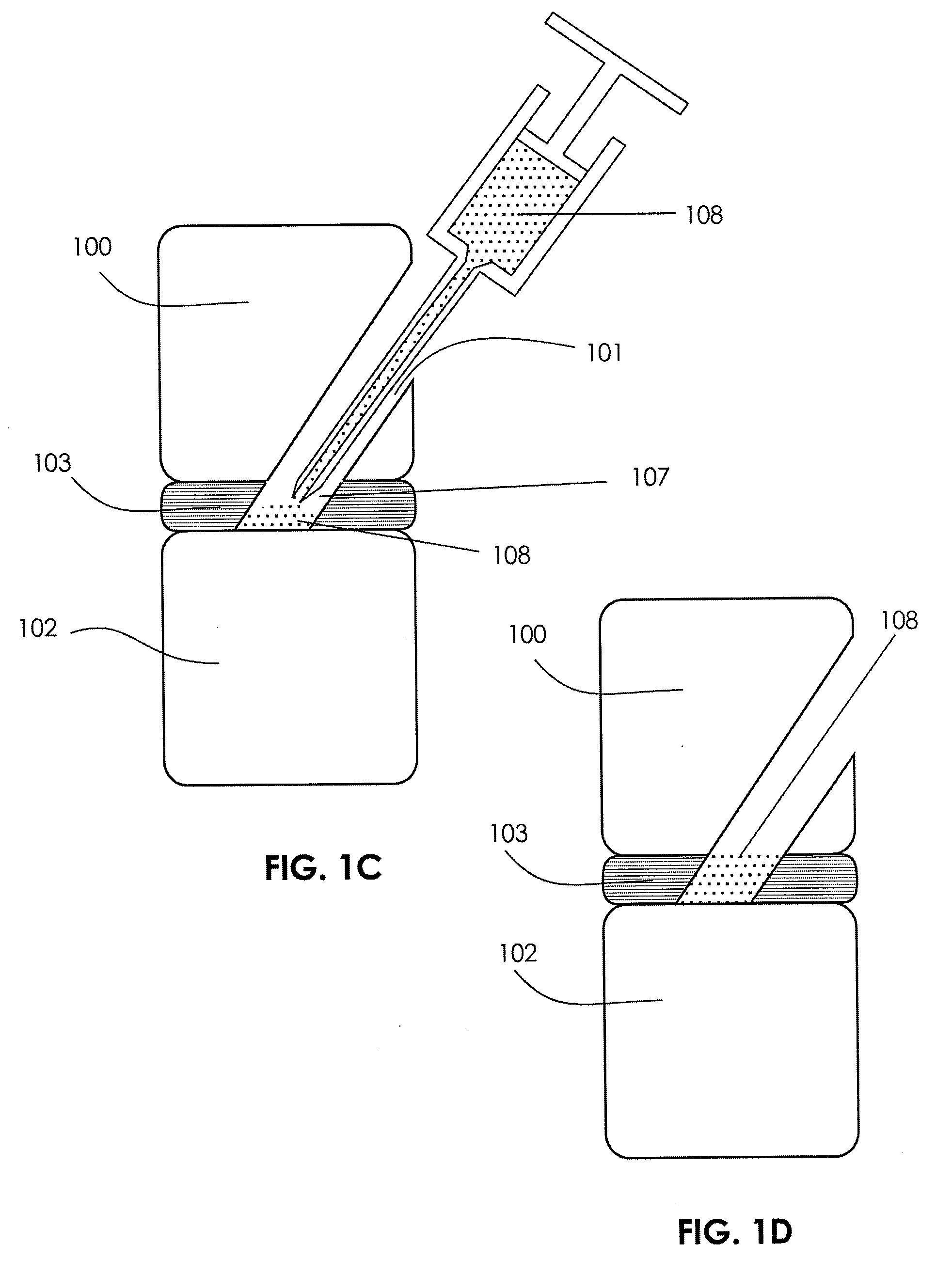 Methods and systems for repairing an intervertebral disc using a transcorporal approach