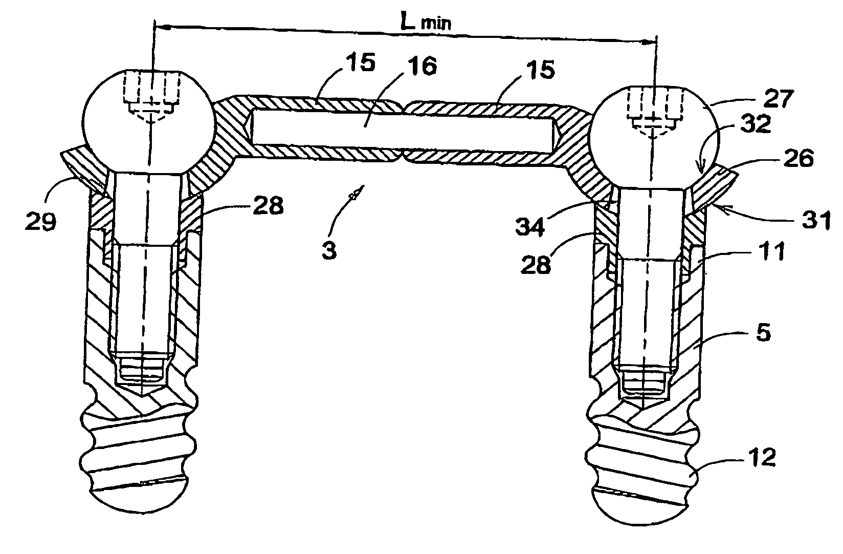 Fastening device for an orthesis or prosthesis