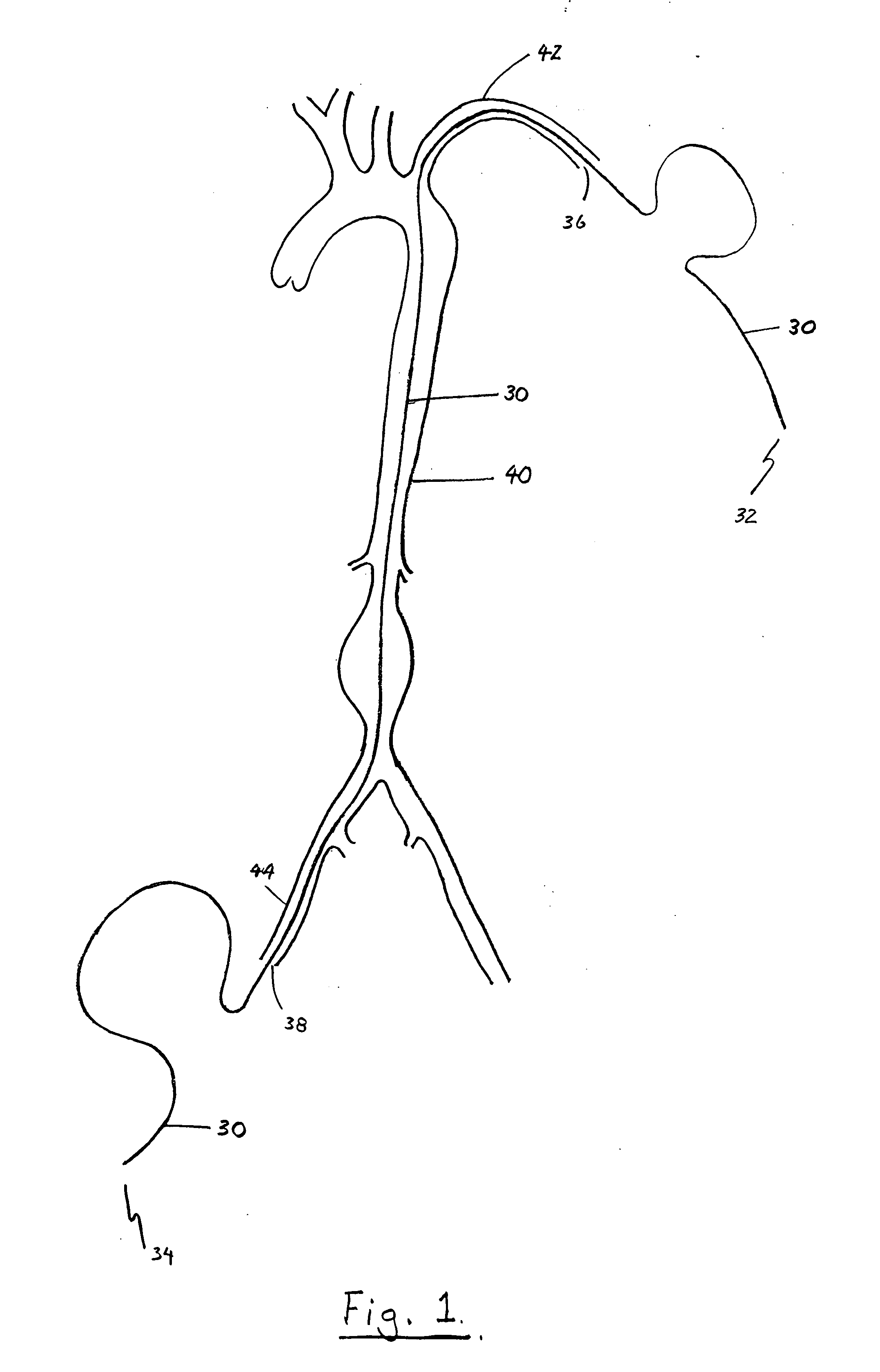 Device and method for staged implantation of a graft for vascular repair