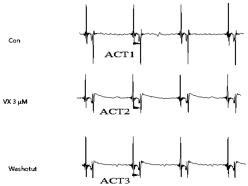 Application of Vanoxerine in medicine for persistent atrial fibrillation