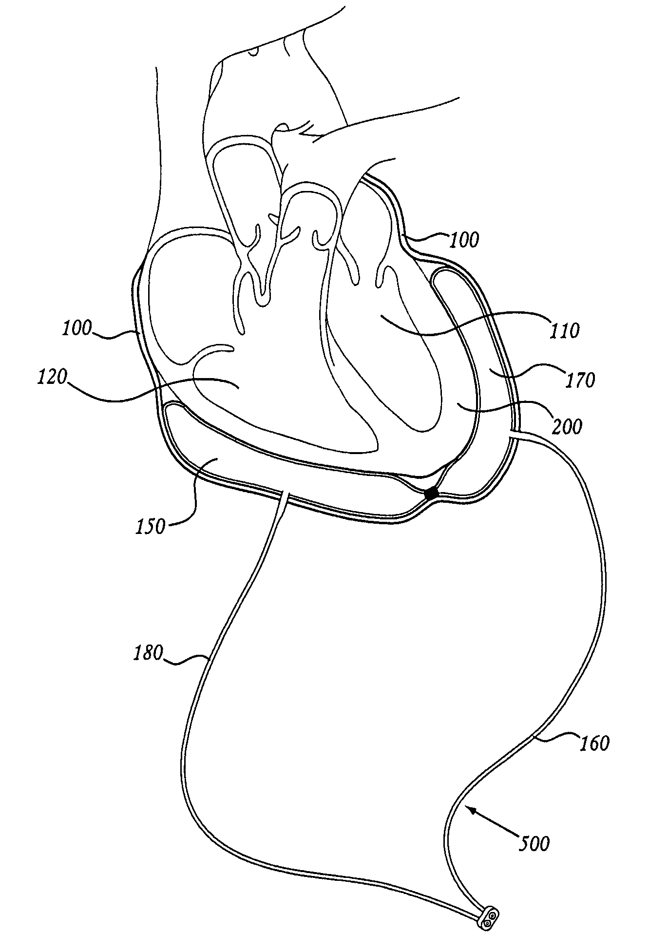 Methods of using pericardial inserts