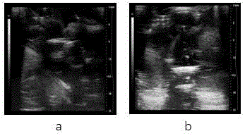 Ultrasound-sensitive liposome and application thereof