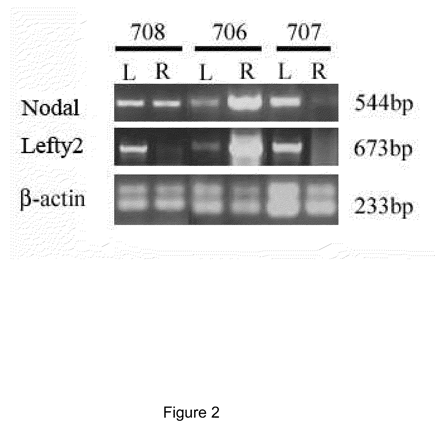 Methods of screening for compounds for use as modulators of left-right asymmetry in scoliotic subjects and for monitoring efficacy of an orthopaedic device