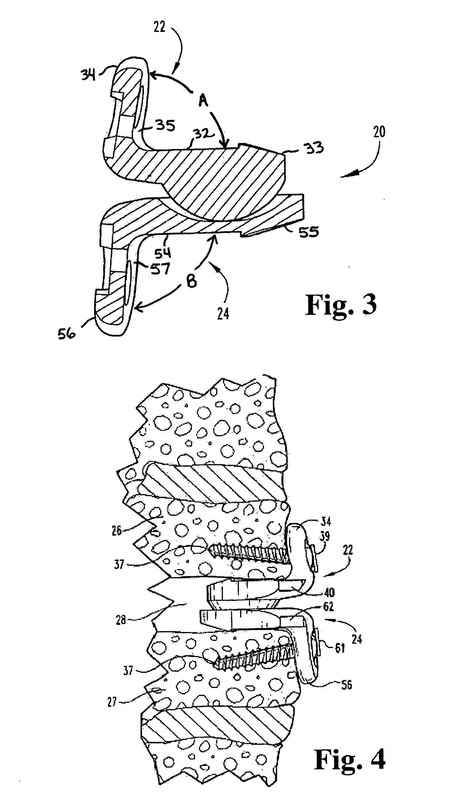 Articulating spinal disc implants with amorphous metal elements