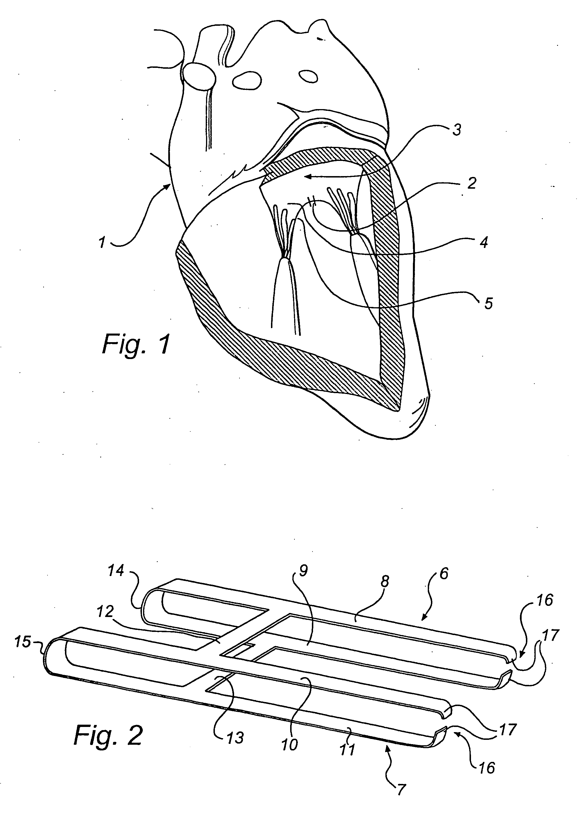 Device and a method for treatment of atrioventricular regurgitation