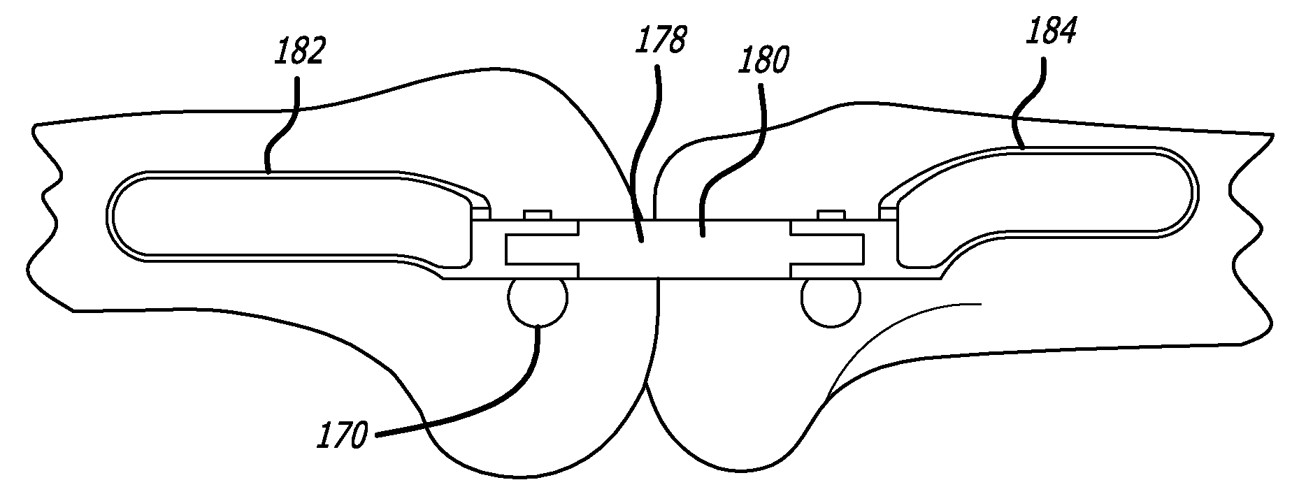 Surgical implantation method and devices for an extra-articular mechanical energy absorbing apparatus