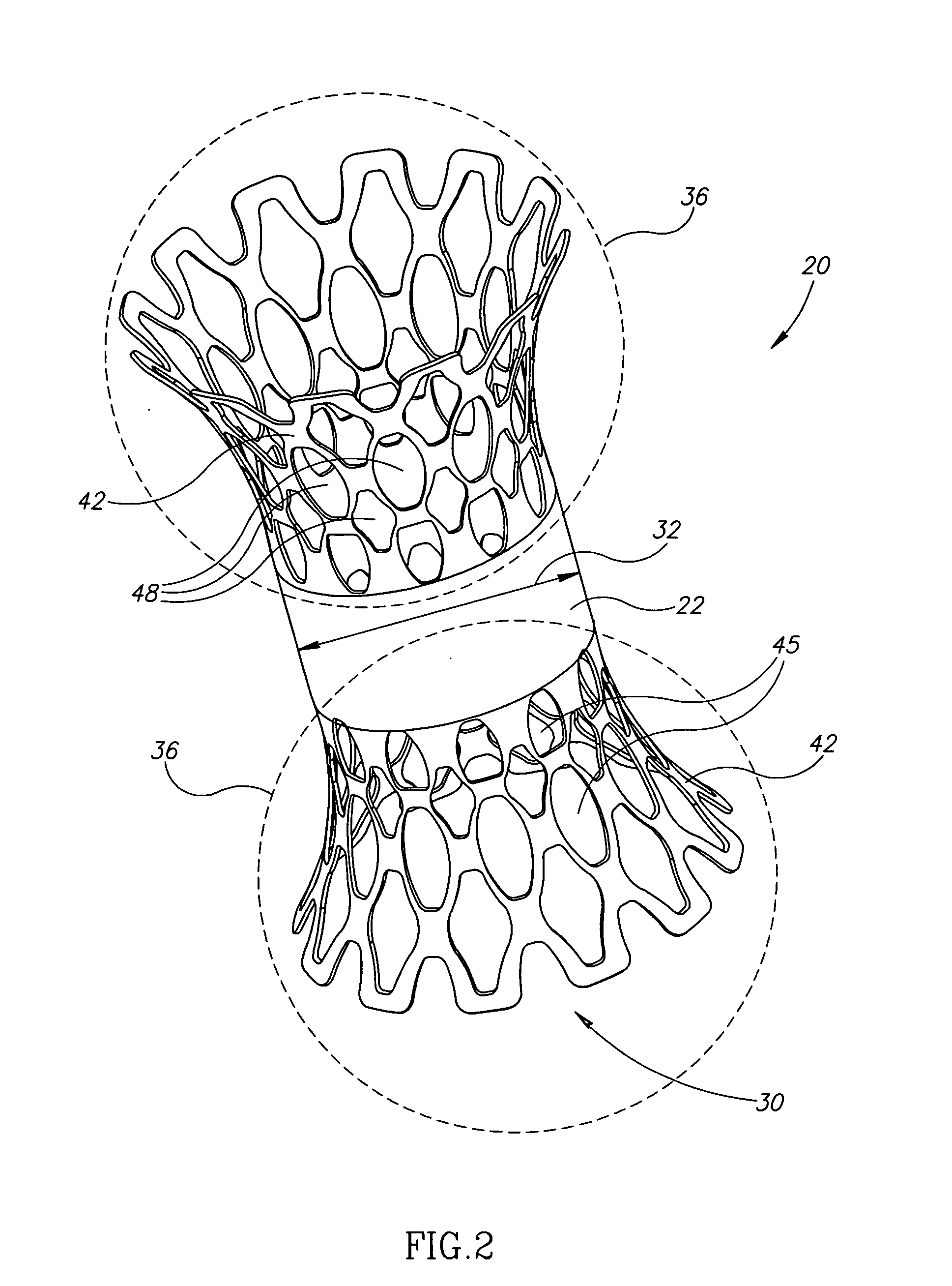 Device and method for treating ischemic heart disease
