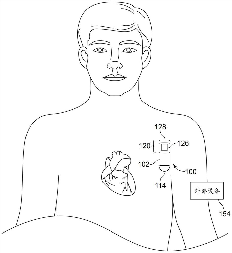 System for identifying preventricular contractions