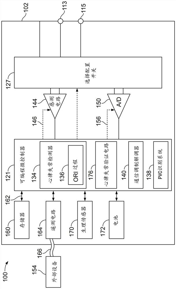 System for identifying preventricular contractions