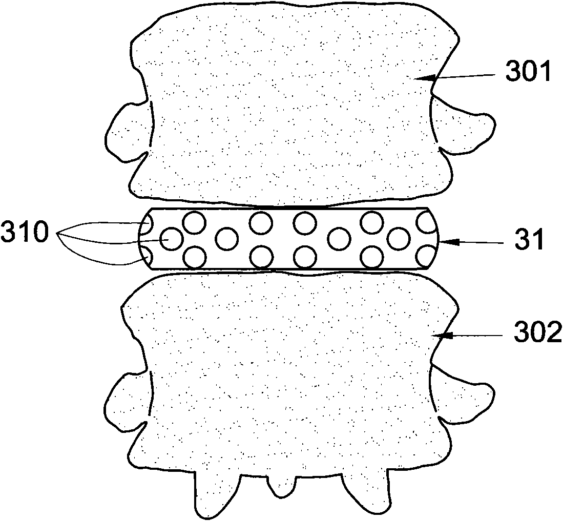 Fixing device for neutralizing actions between two vertebral bodies