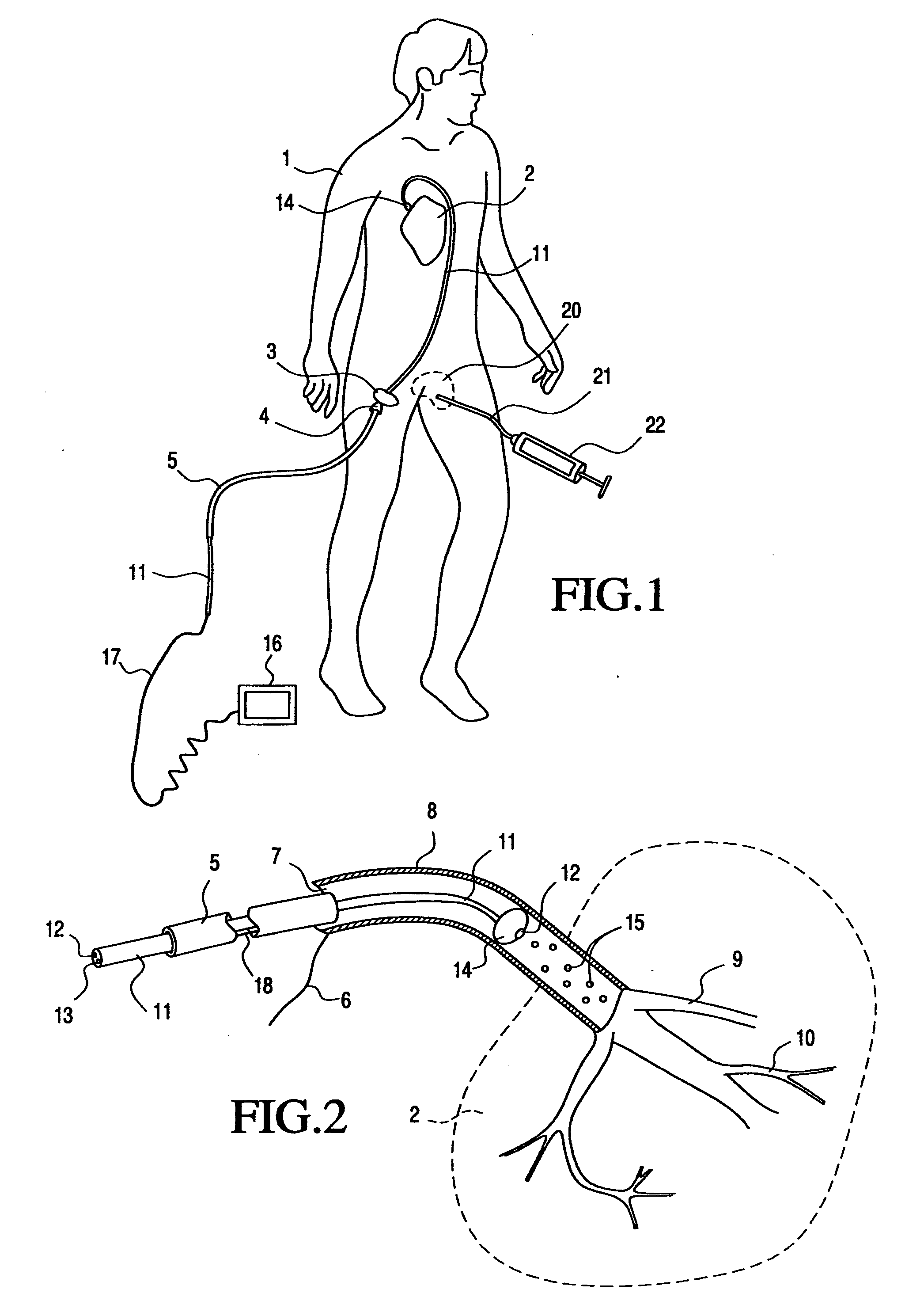 Method and instrumentation for control of stem cell injection into the body