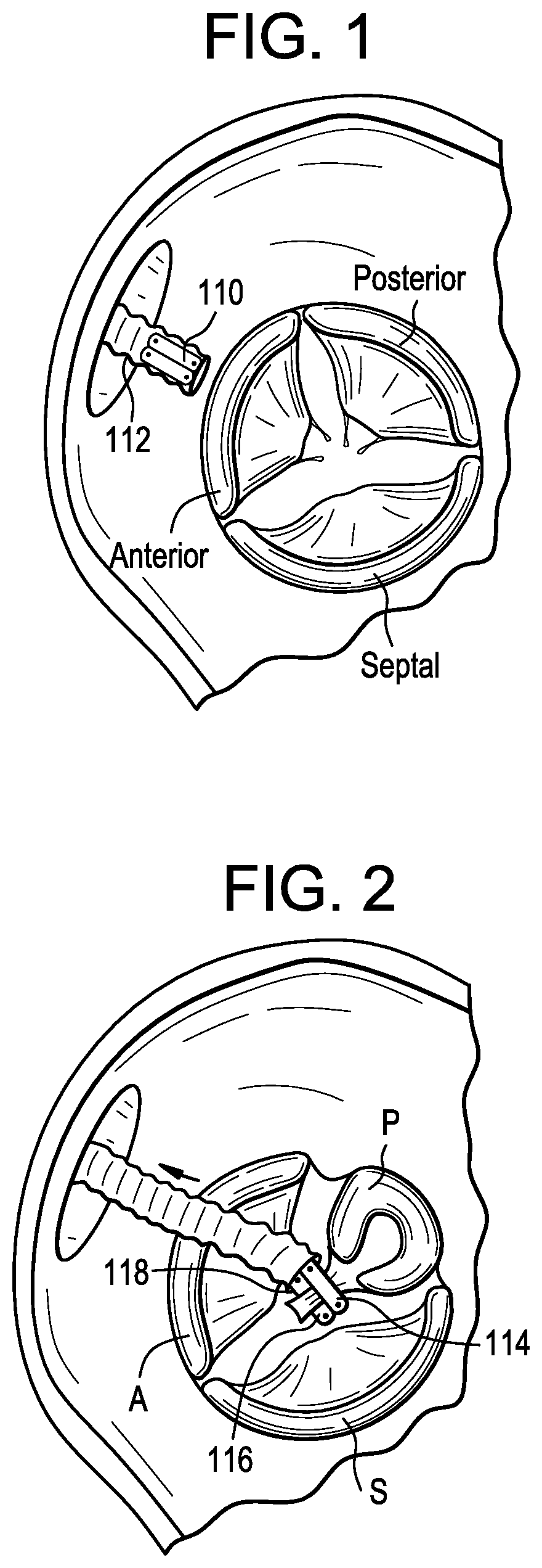 Device and method to plicate the tricuspid valve