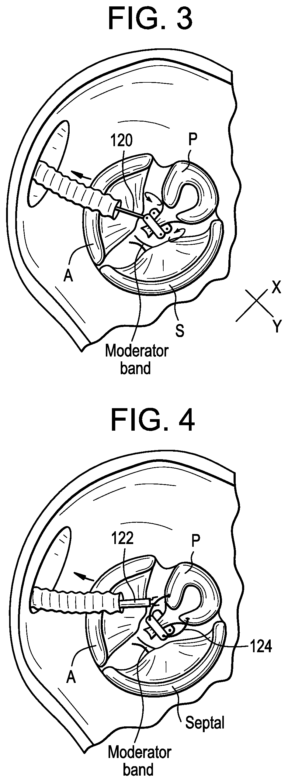 Device and method to plicate the tricuspid valve