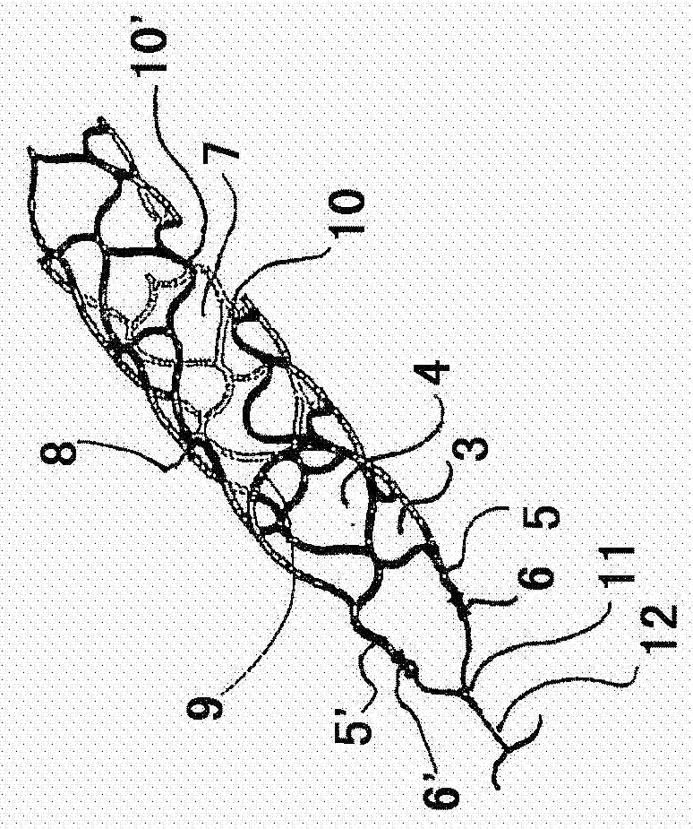 Thrombectomy equipment