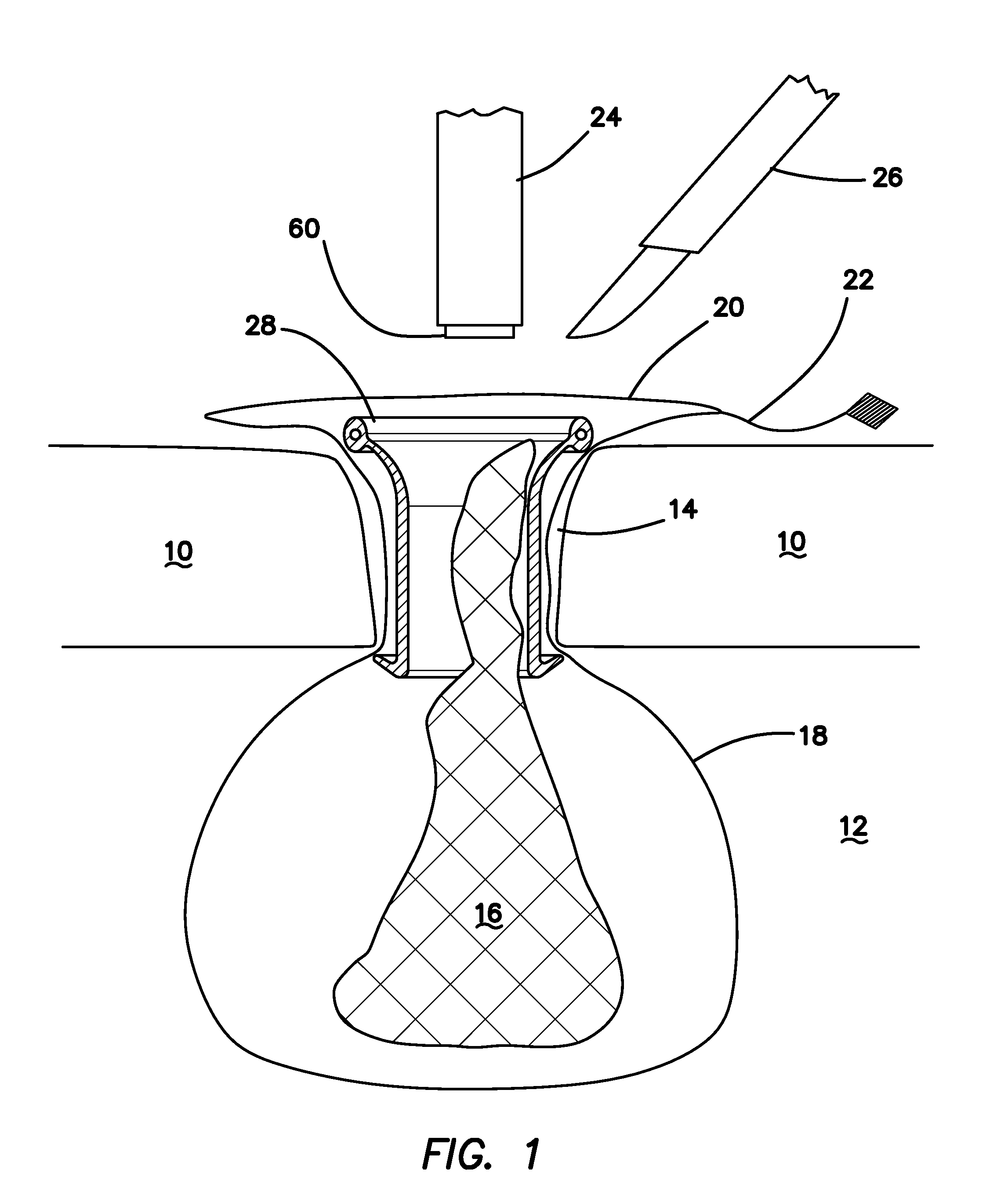 System and methods for tissue removal