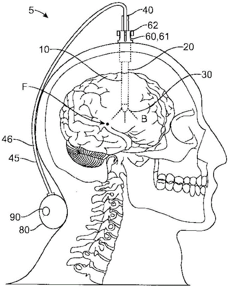 Apparatus, systems and methods for delivery of medication to the brain to treat neurological condidtions