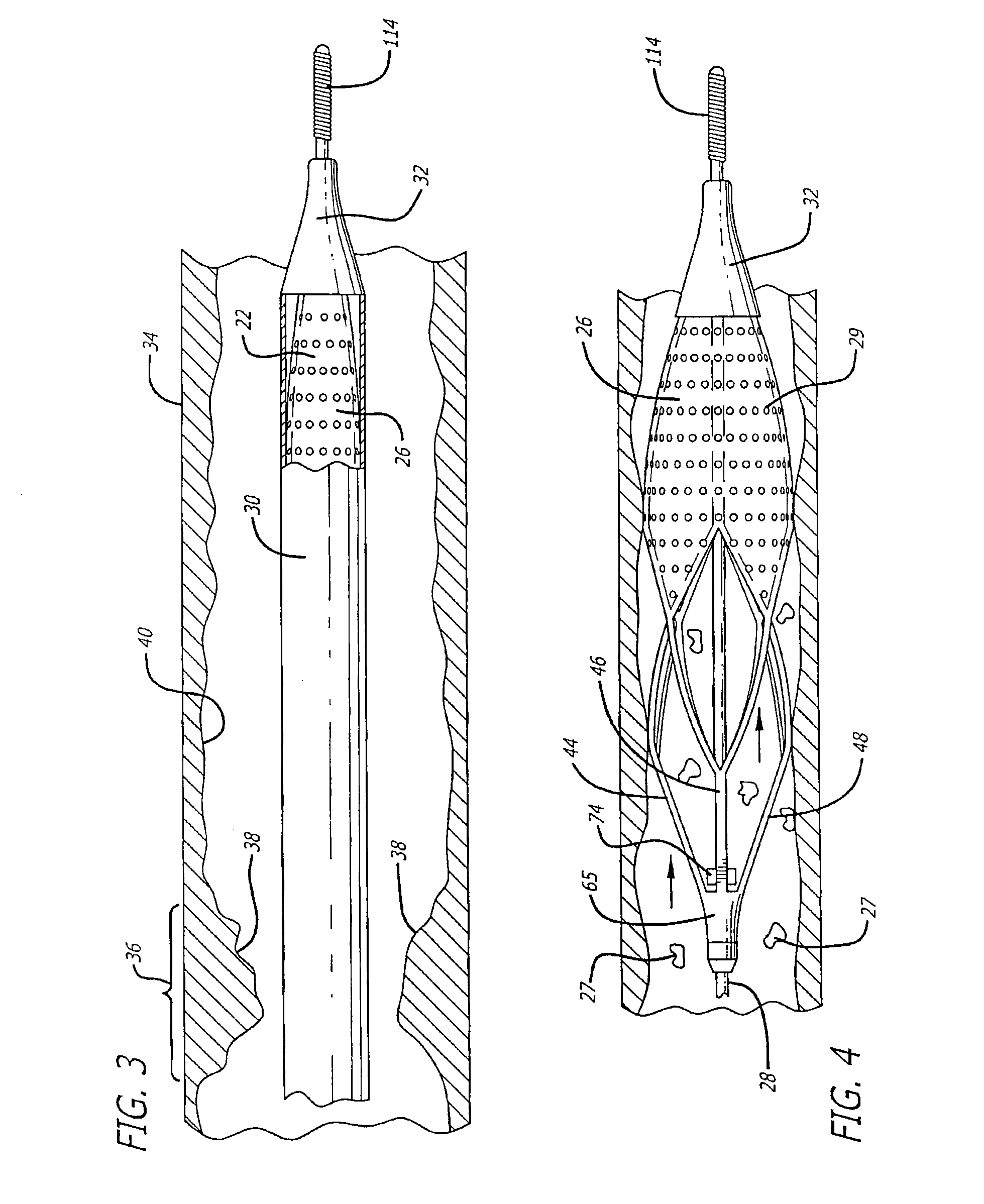 Cage and Sleeve Assembly for a Filtering Device
