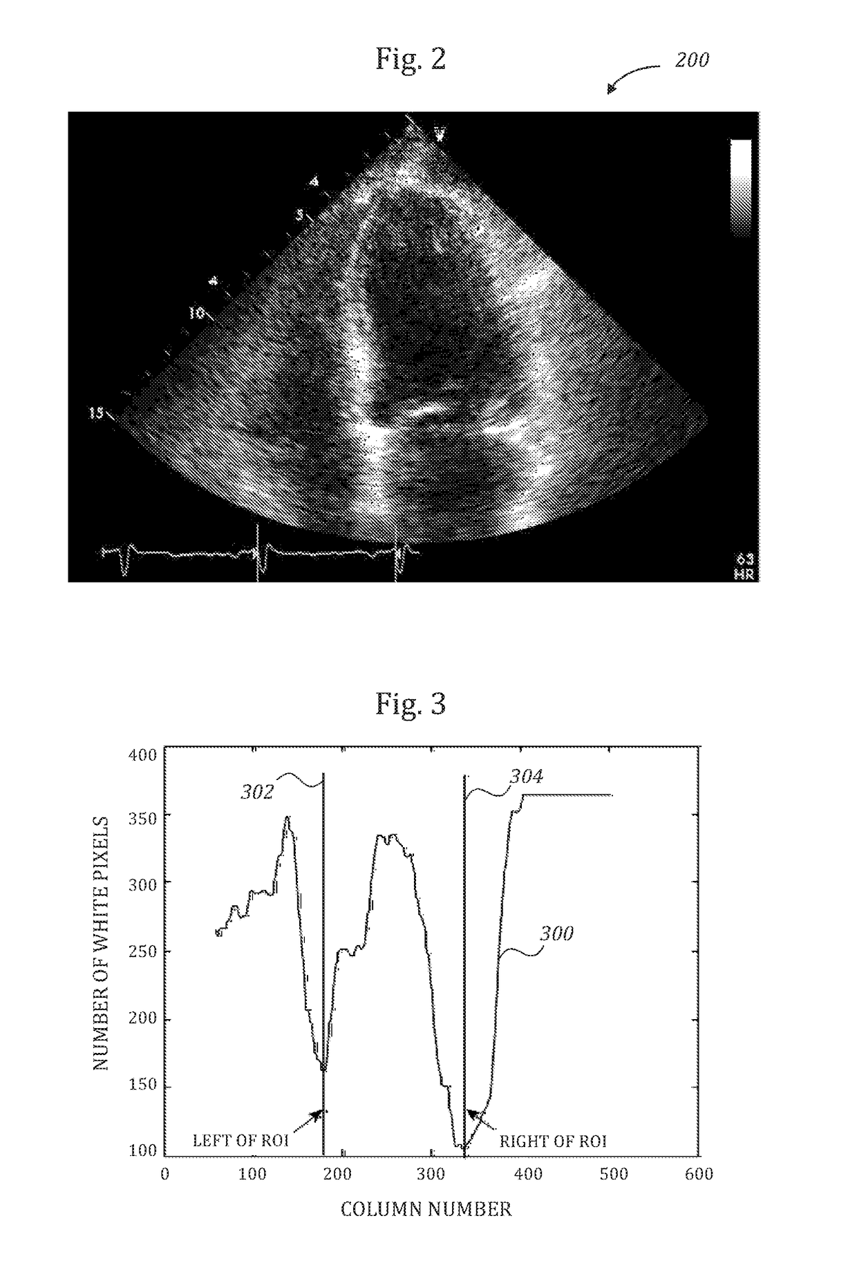 Automatic left ventricular function evaluation