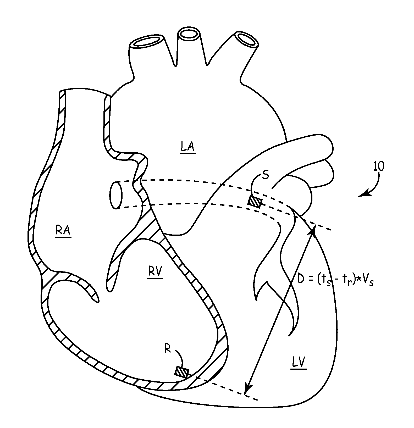 Method and apparatus for evaluating ventricular performance during isovolumic contraction