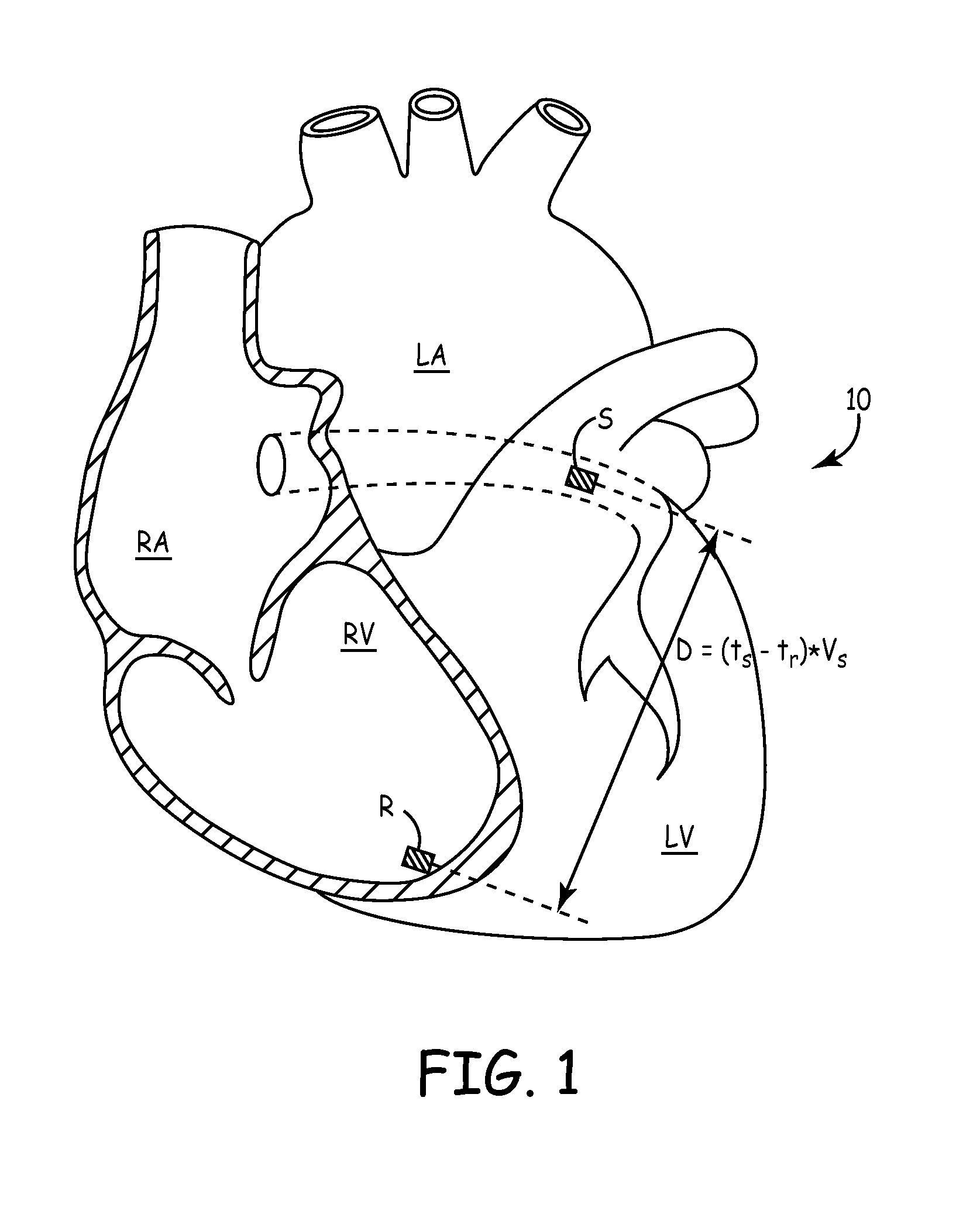 Method and apparatus for evaluating ventricular performance during isovolumic contraction