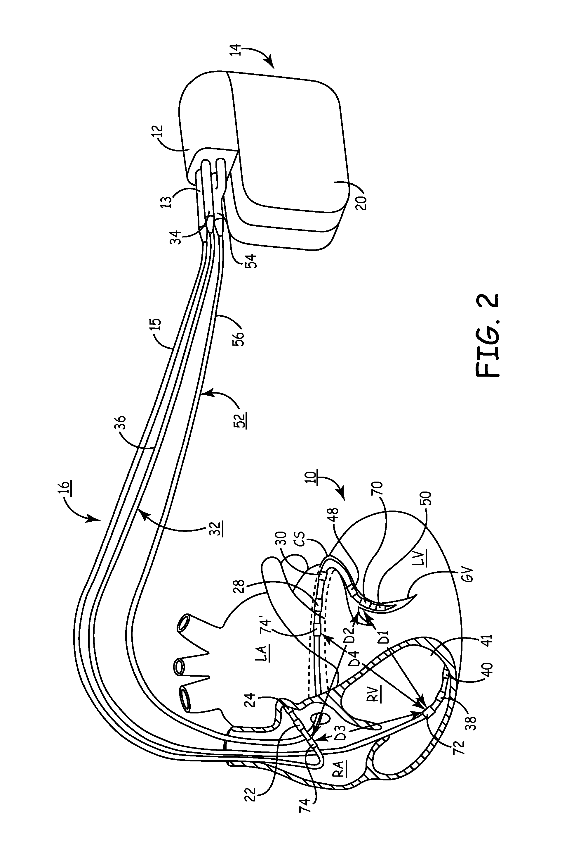 Method and apparatus for evaluating ventricular performance during isovolumic contraction