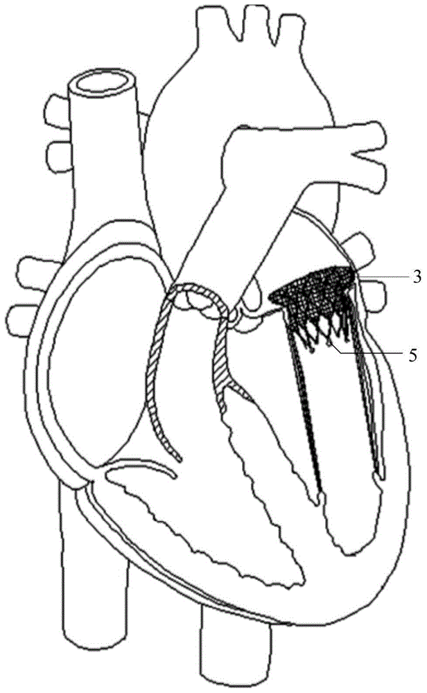 Involved artificial heart valve prosthesis