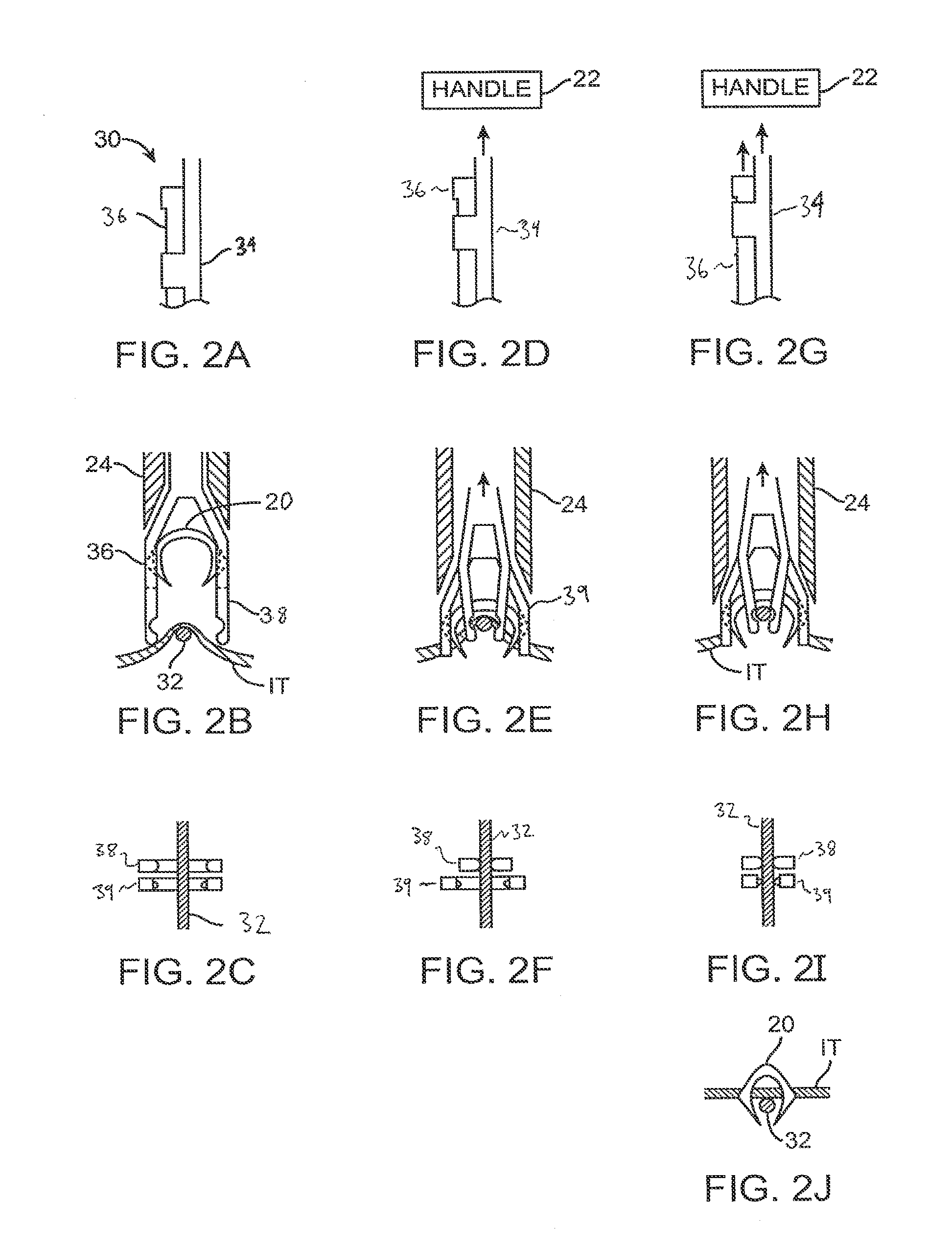 Fasteners, deployment systems, and methods for ophthalmic tissue closure and fixation of ophthalmic prostheses and other uses