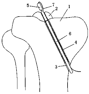 Minimally invasive fixation device for tibial intercondylar spine fracture