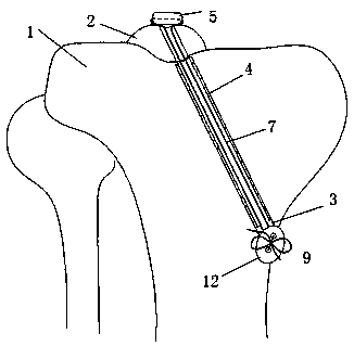 Minimally invasive fixation device for tibial intercondylar spine fracture