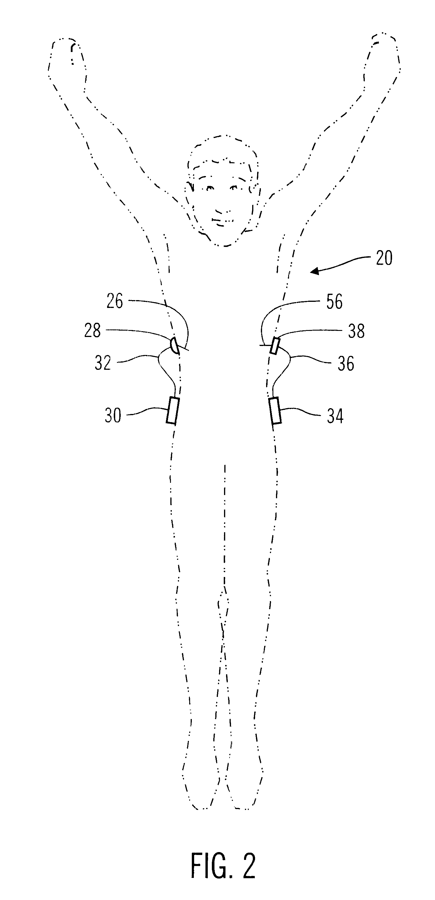 Closed loop system for controlling insulin infusion