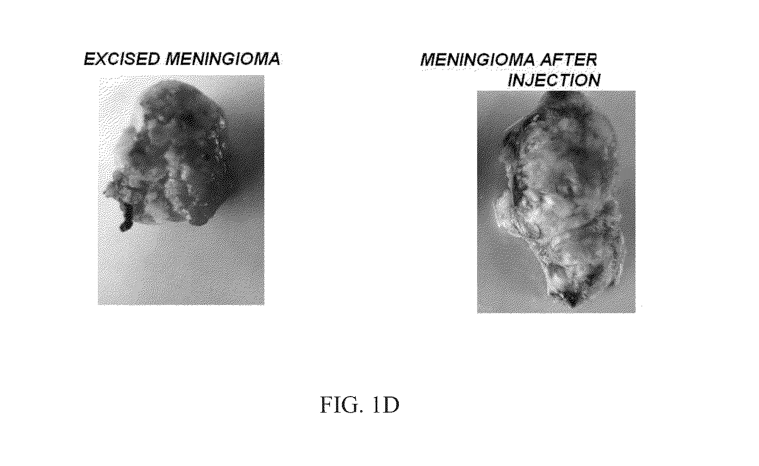 Halogenated aliphatic carboxylic acids, oligomers and/or polymers thereof and their use in devitalizing external and internal neoplasms