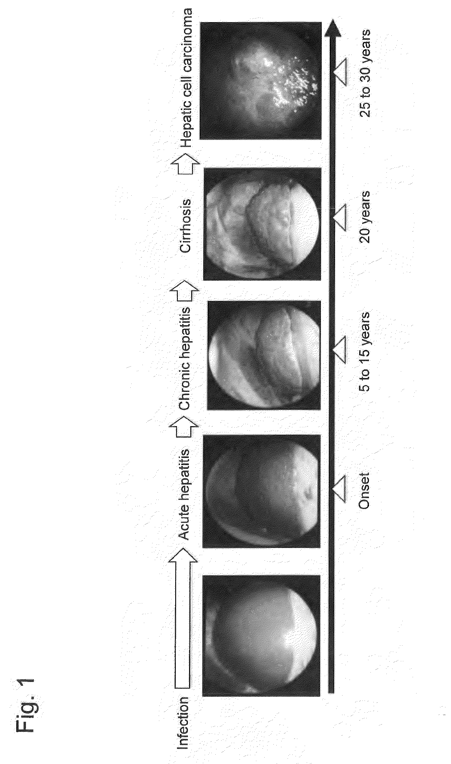 Method for Measuring Glycoprotein, Method for Examining Liver Desease, Reagent for Quantitative Determination of Glycoprotein and Glycan-Marker Glycoprotein as an Index for Clinical Conditions of Liver Disease