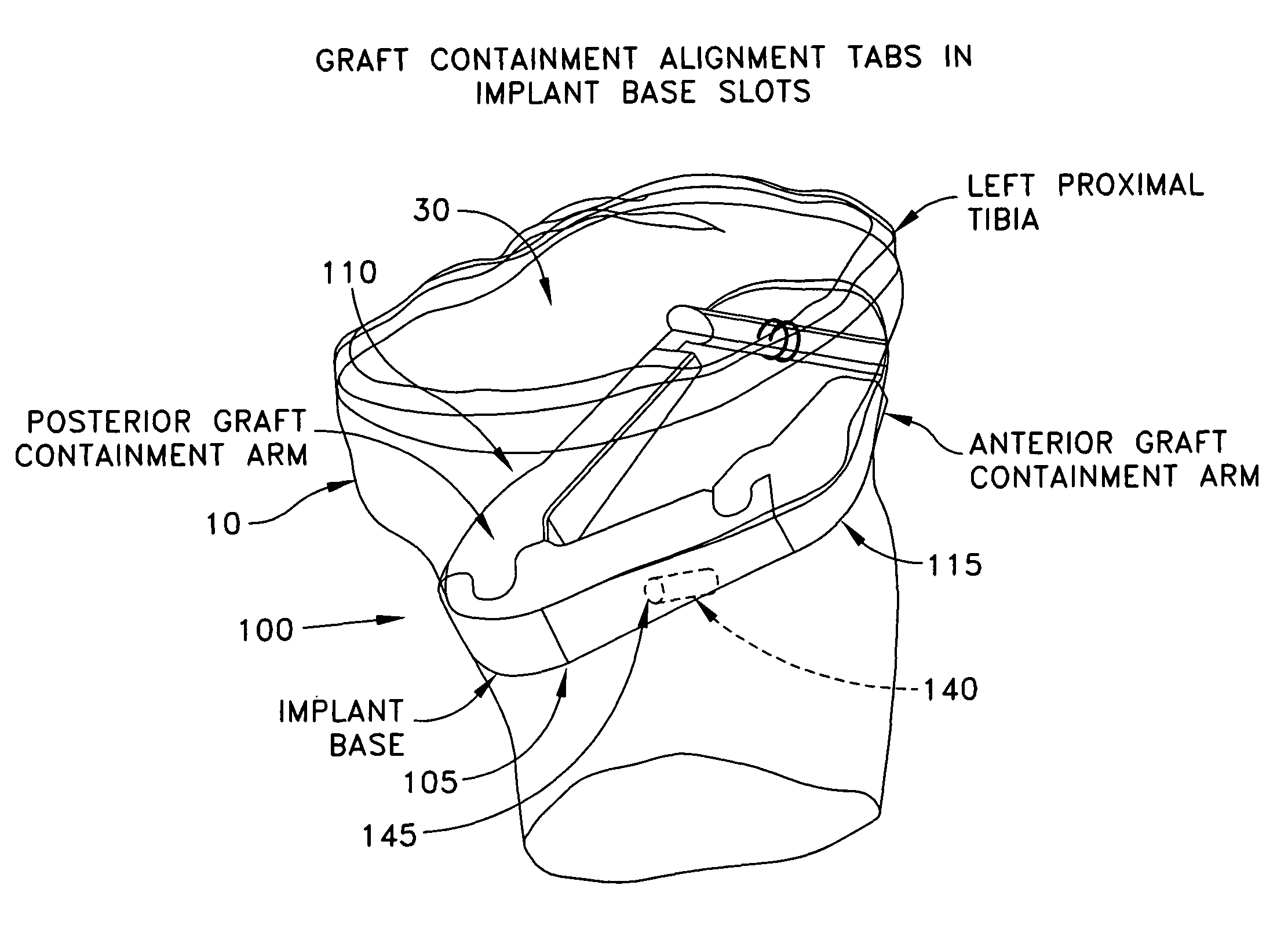 Multi-part implant for open wedge knee osteotomies